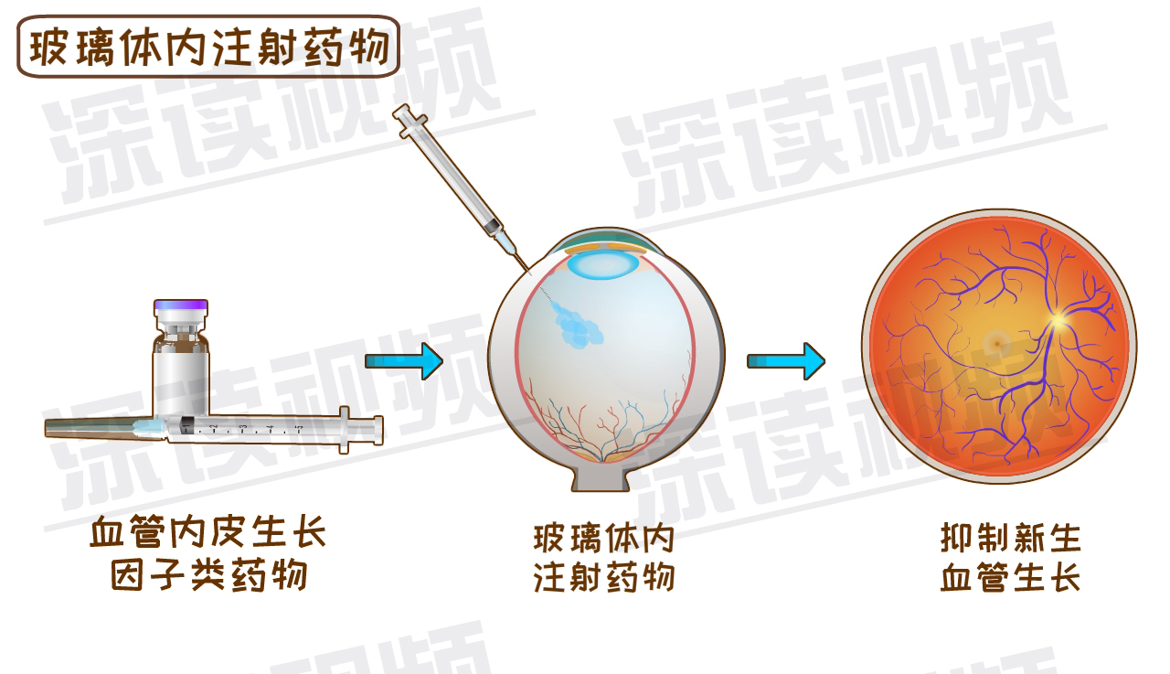 眼科眼底病激光设备种类有哪些